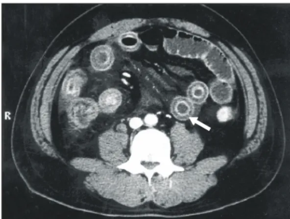 Fig.  3.  Contrast  CT  scan  shows  dilated  bowel  wall  thickening  of  the  ileum  and  ascending  colon  with  a  layered  appearance  of  wall   enhance-ment,  target  sign  (white  arrow)