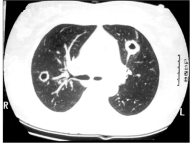 Fig.  1.  Chest  PA  shows  thick  walled  cavitary  lesions  (ar- (ar-rows)  in  right  mid-lung  field  and  hilar  area  of  left  mid-lung  field.