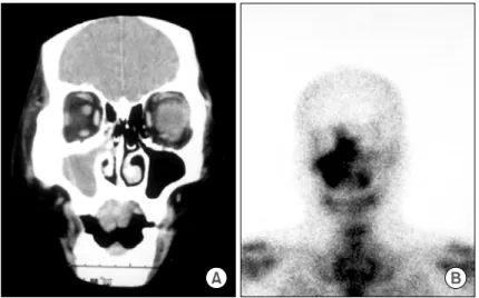 Fig.  3.  (A)  Paranasal  sinus  CT  shows  right  maxillary  sinus  mass  lesion.  (B)  Bone  scan  with  99m Tc-  methylene  diphosphonate  shows  intense  increased  uptake  in  the  right  maxillary  sinus,  suggesting  sinusitis.