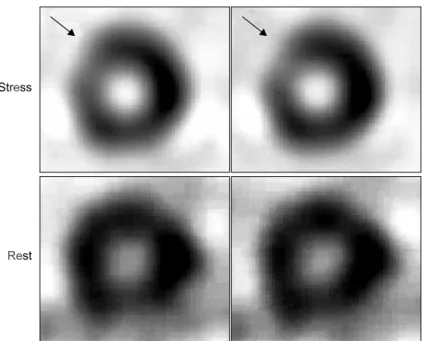 Fig.  5.  Thallium/technetium  myocardial  perfusion  SPECT  shows  a  reversible  small,  mild  perfusion  defect  in  the  mid  anteroseptal  region.
