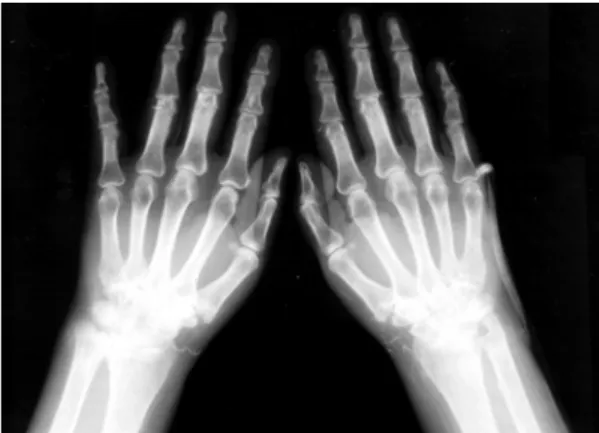 Fig.  1.  Both  hands  X-ray  shows  bony  erosions  on  both  wrists.