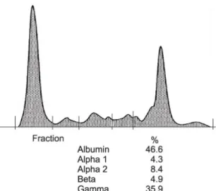 Fig.  1.  Serum  protein  electrophoresis  showed  a  M  com- com-ponent.
