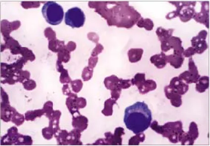 Fig.  2.  Immunoelectrophoresis  of  serum  identified  M  component  as  a  IgG-λ type.