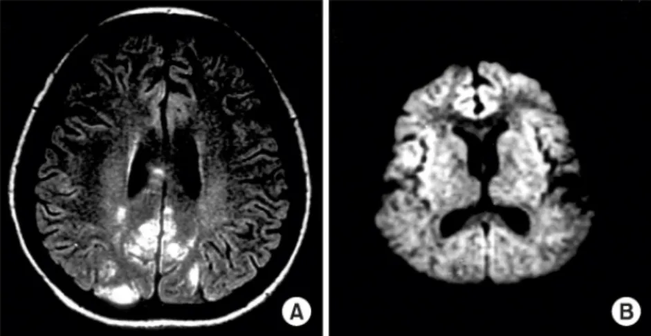 Fig.  2.  A.  MR  study,  which  was  performed  after  4th  seizure  attack  (after  cyclophosphamide  pulse  therapy),  shows  extensive  subcortical  white  matter  edema  with  minimal  cortical  involvement