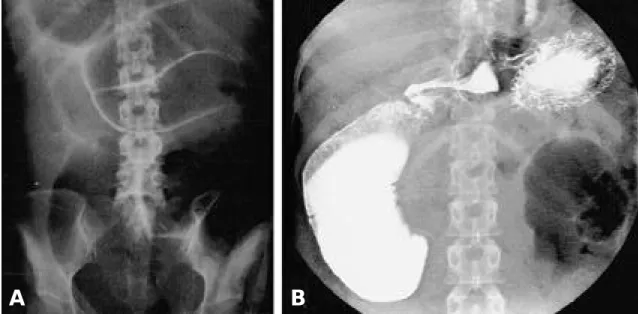 Fig. 2-A. Simple abdomen X-ray shows severe degree of small and large intestinal dilatation suggesting p s e u d o o b s t r u c t i o n .