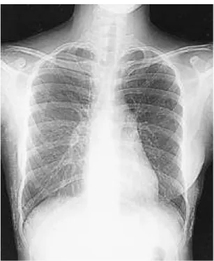 Fig. 1. Anteroposterior view of the chest shows diffuse subcutaneous calcification of the thoracic wall