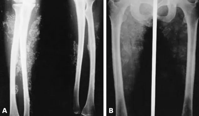 Fig. 2. A) Both forearm X-ray shows diffuse subcutaneous calcification of upper extremities Fig 2