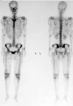 Fig. 4. Right thigh CT scan shows calcification limited to subcutaneous tissue