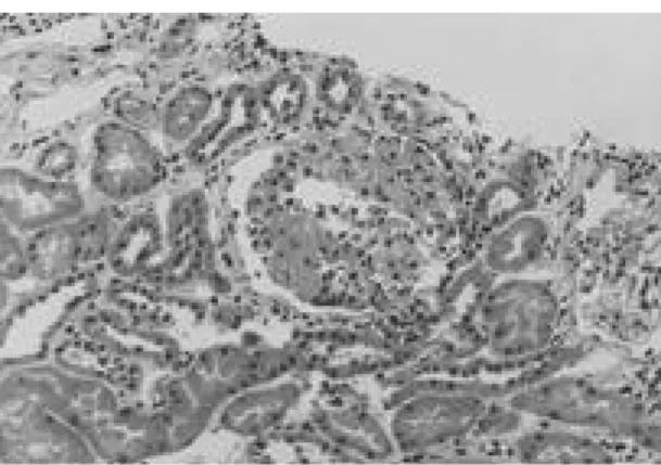 Fig. 2. Eosinophils in the interstitium. Many plas- plas-ma cells, lymphocytes and two eosinophils infiltrated in the interstitium