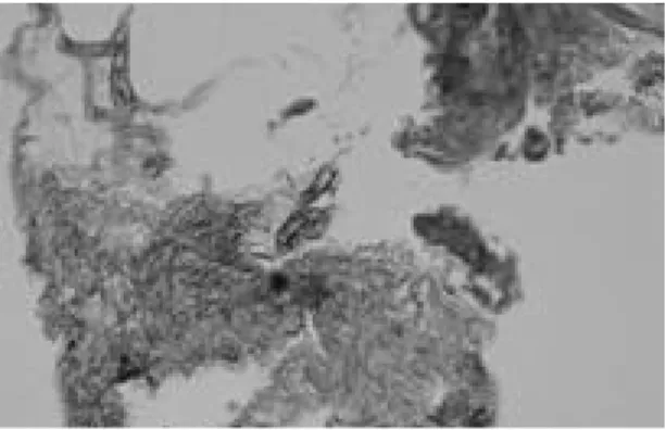 Fig. 1A. Bone marrow biopsy shows diffuse myelofi- myelofi-brosis with increased amounts of fibrillar reticulin (Reticulin staining, ×4 0 0 )