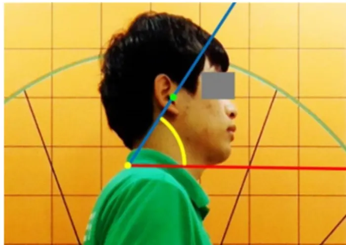 Figure 1. Cranial vertical angle 