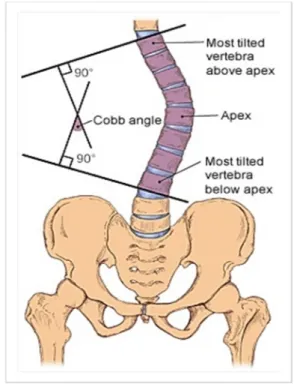 Figure 8. Cobb's angle method (Renee L. Cannon, 2002.) 