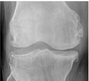 Figure 1. Radiography of Right knee osteoarthritis (Kellgren-Lawrens scale III)