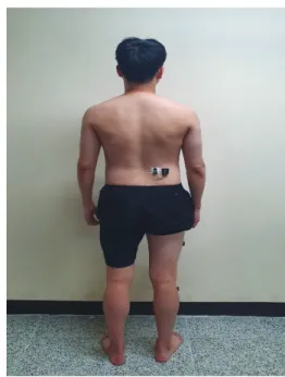 Fig.  4.  EMG  attachment  site.
