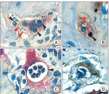 Fig. 4.  Representative images of tartrate-resistant acid phosphatase-pos- phosphatase-pos-itive multinucleated osteoclasts containing several vacuoles with individual  inclusions or several inclusions within one vacuole in the diabetes with  periodontitis