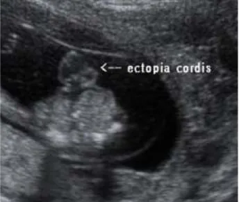 Fig.  1.  Sonographic  findings  of  execephaly.