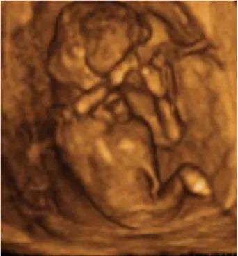 Fig.  5.  Gross  findings  of  fetus  with  chest  wall  defects  and  excencephaly.     염색체 결과 : 태아의 태반조직을 절제하여 실온 보관 후 염색체 검사를 보냈으나, 검체의 오염으로 결과가 나 오지 않았다