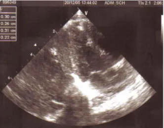 Fig. 2. Postnatal transthoracic echocardiogram showing  3.0×2.6  mm  and  3.1×2.2  mm  multiple  masses  at  midseptum