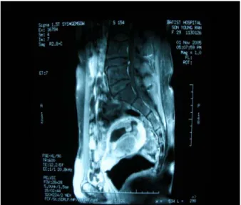 Fig. 1. Transvaginal ultrasound scan of a 6-week ges- ges-tation  showing  the  typical  features  of  a  hydatidiform  mole  and  a  normal  coexisting  fetus