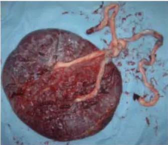 Fig.  1.  Placenta  and  two  umbilical  cords  showing  severe  entanglement.