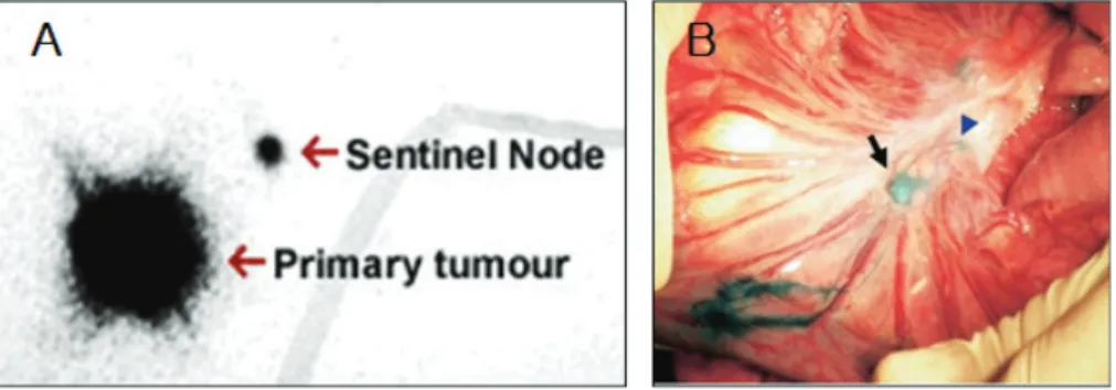 그림  2.  SLN  mapping  by  radio-guided  (A)  and  dye-guided  method  (B) 5