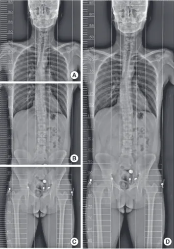 Fig. 6은 세 장의 파노라마식 X선 영상을 정합한 것이다. Fig. 6A-C 에 MFP를 적용하지 않고 영상 도메인에서 NCC를 계산하여 정합 한  결과 영상이 Fig