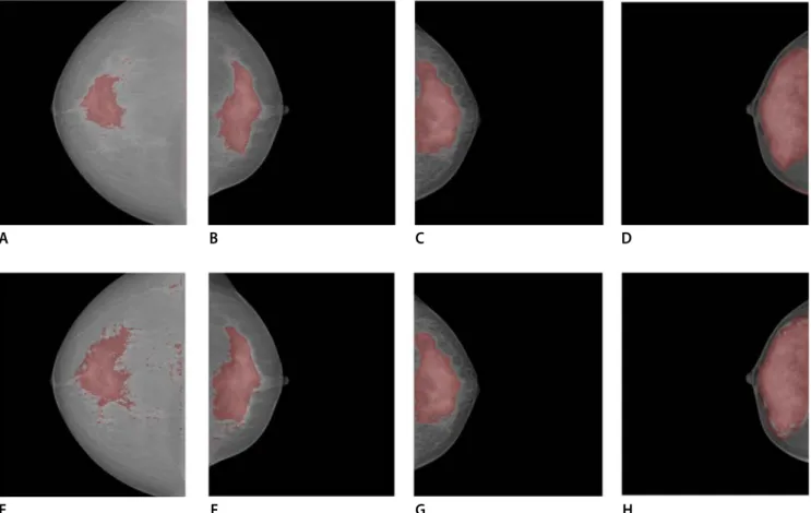 Fig. 5. Overlaid dense area boundaries of example mammogram: Shown in (A) - (D) are the boundaries drawn from the  experts, and in (E) - (H) are the boundaries produced by the CNN.