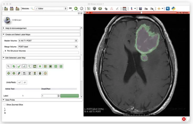 Fig. 3. Segmentation of GBM. Segmentation was carried out using the drawing tool in 3D Slicer [20]