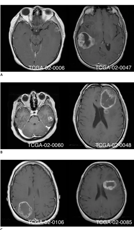 Fig. 4. Example cases with (A) low area (left) and high area (right) of contrast-enhancing lesion, (B) low area (left) and high area  (right) of necrosis, (C) low uniformity (left) and high uniformity (right) of contrast-enhancement
