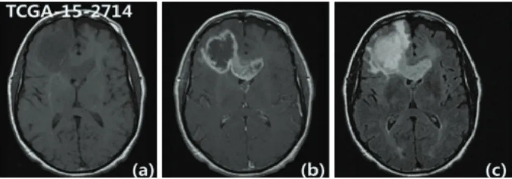 Figure 1. An example of TCIA GBM data; (a) T1W-Pre, (b) T1W-Post CE, (c) FLAIR.