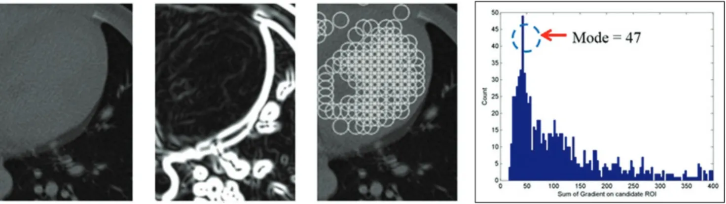 Figure 2. (a) An example of an enlarged version of CT image, (b) The gradient image of (a), (c) Detected homogeneous region by proposed method, (d) The histogram of a sum of gradient on candidate regions of interest.