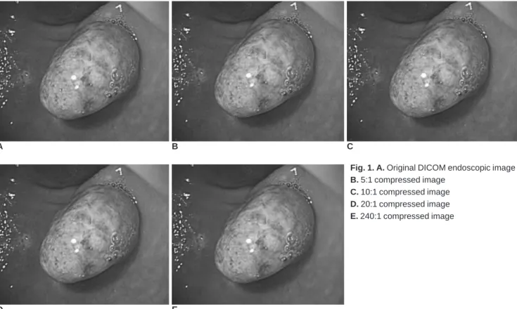 Fig. 1. A. Original DICOM endoscopic image B. 5:1 compressed image