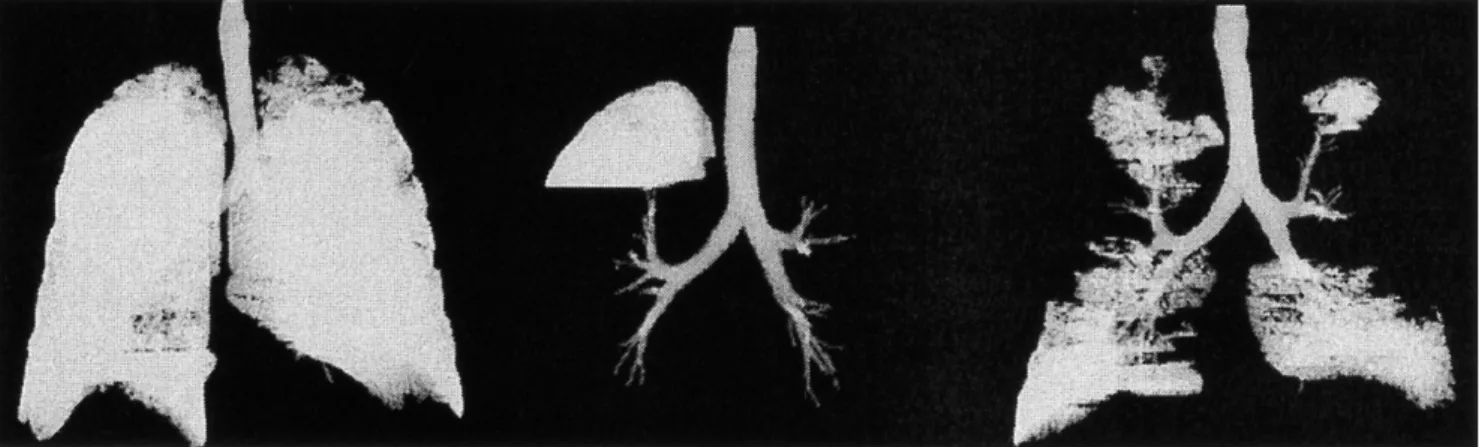 Fig. 7. Comparative results of airway seg- seg-mentation; (A) proposed method (small  leak-age was occurred at the left upper location).