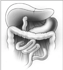 Fig. 1. Diagram of the completed hepatic portoenterostomy procedure. 3. 본 연구의 목적 다른 만성 소화기 질병에서와 마찬가지로, 소아 담도 폐쇄증  환자들의 영양 공급은 매우 중요하고 어려운 문제이다