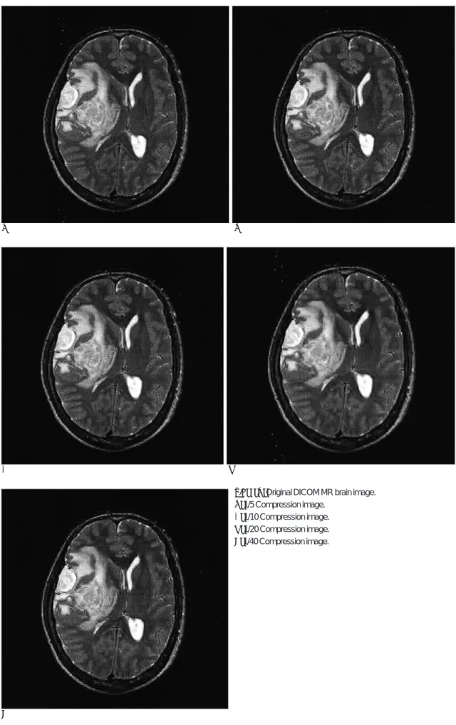 Fig. 1. A.Original DICOM MR brain image.