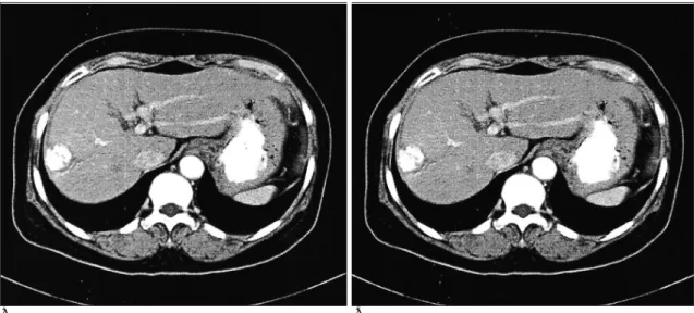 Fig.  2. A. Original DICOM iabdominal CT image.