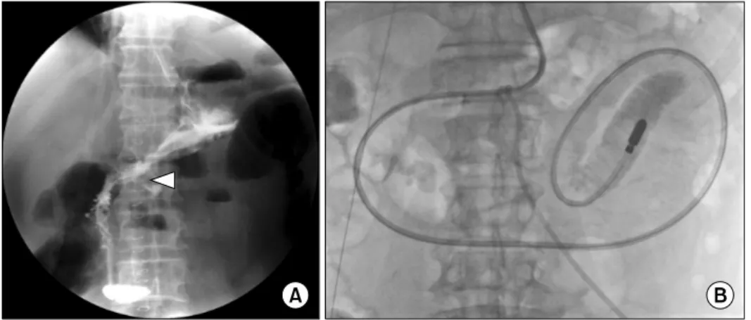 Fig. 1. (A) Anastomotic leakage at the gastroduodenostomy site (arrowhead)  after distal gastrectomy