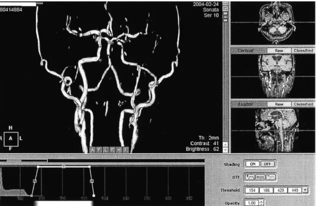 Fig. 2. MIP of non-enhanced 3D volume rendering TOF MR Angiography. Display ranges of 3D volume rendering in opacity transfer func- func-tion at the histrogram.