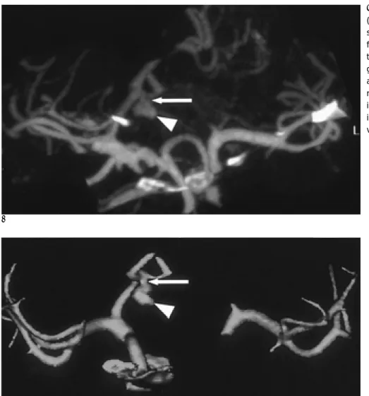 Fig. 4. (A) CT angiography using MIP (gantry angle = 15 degree, pitch = 1.0) shows a aneurysm (arrowhead) arising from anterior communicating artery and the neck of aneurysm (arrow)