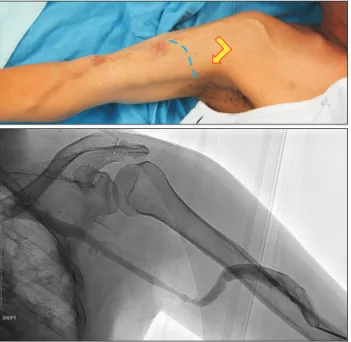 Fig. 1.  Cephalic vein의 주행경로와 특징, 위팔에서 약간 가늘어 진다. 쇄 골 부위에서 위 아래의 근육 사이를 지난 후 Axillary vein에 90도 각도로 