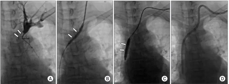 Fig. 2. A 74-year-old female patient with an obstructed left internal jugular vein. The right internal jugular vein was also obstructed (not  shown)