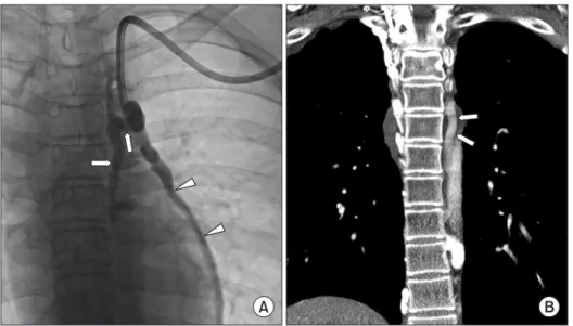Fig. 6. Hemodialysis catheter into  the accessory hemiazygos vein in  a 17-year-old male patient with  bilateral brachiocephalic veins and  superior  vena  cava  obstruction