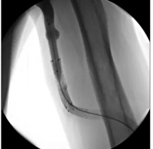 Fig. 1. Additional stent placement in venous anastomosis site of  brachiobasilic AVG.