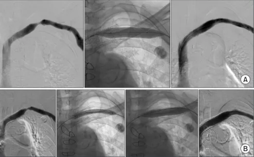 Fig. 1. An example of PTA with drug-coated balloon for hemodialysis circuit stenosis. This 78 year-old female patient with a left  forearm arteriovenous graft has history of stent placement in the left brachiocephalic vein