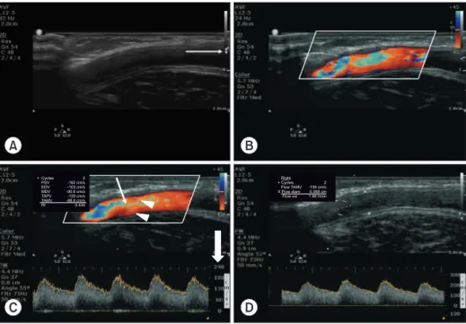 Fig. 1.  Doppler US surveillance of arteriovenous graft (AVG). A 73-year-old woman with brachio-axillary AVG had undergone 7 times  balloon angioplasty and a stent-graft placement for 2 years follow-up