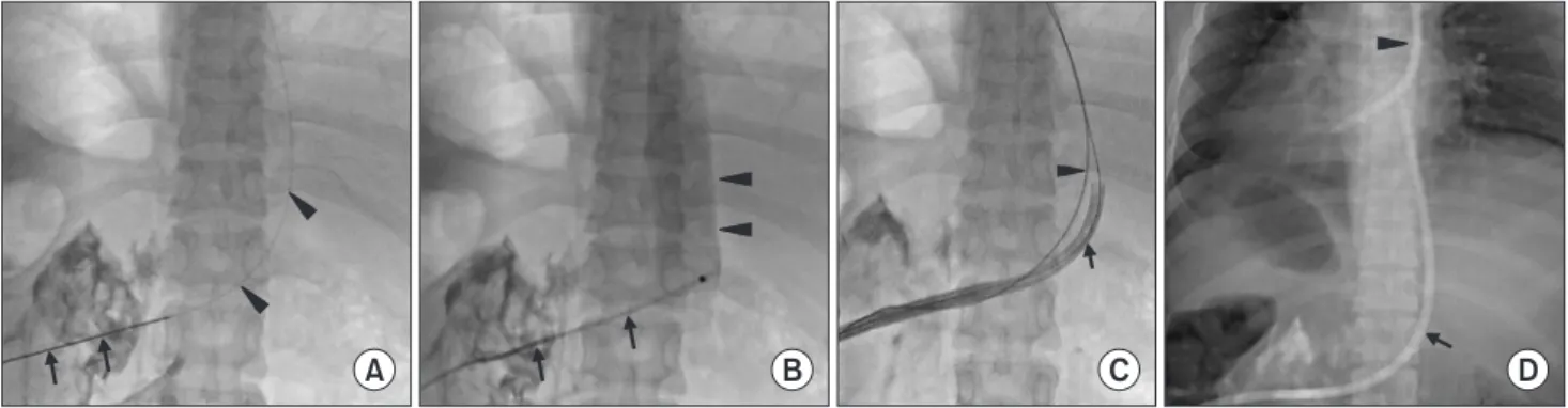 Fig. 1. Transrenal inferior vena cava (IVC) access in a 31-year-old female patient with exhausted central venous access