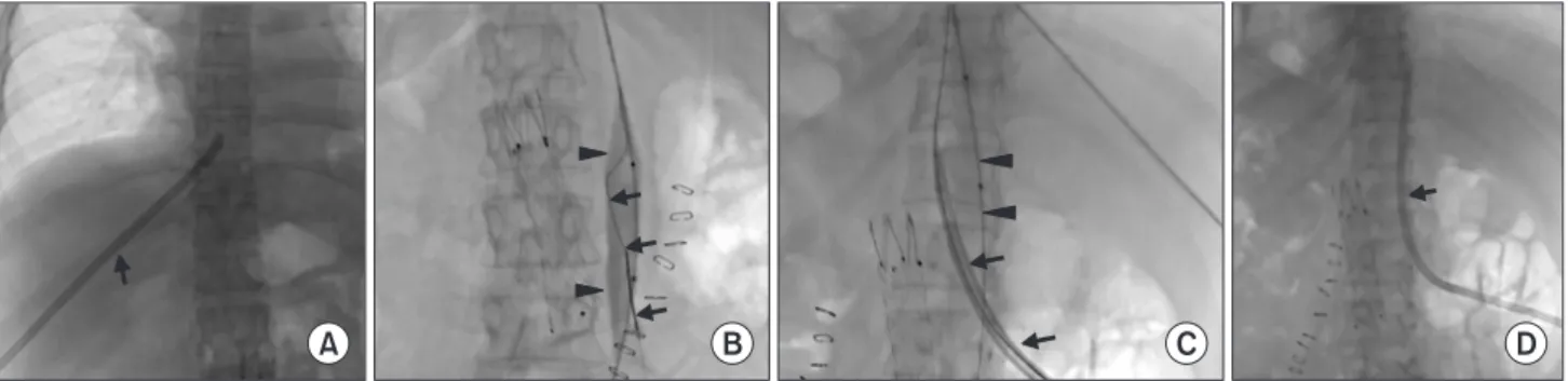 Fig. 2. Translumbar inferior vena cava (IVC) access in a 48-year-old female patient with exhausted central venous access