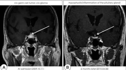 Fig. 1. Patient’s sella MRI findings. A :  Suggestive of suprasellar  mass(ar-row indication, about 9mm in size)  was seen at admission on internal  medicine department