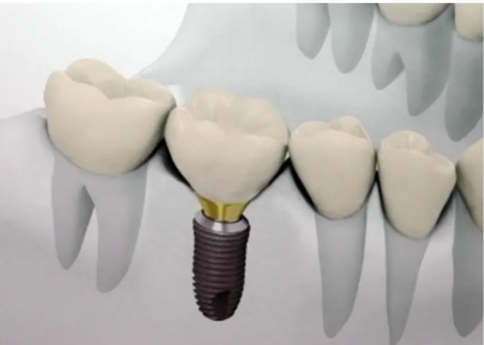 Fig. 1 Dental implant installed in human mandible록 생체역학적으로 설계되어야 한다. 보철물에 영향을 주는 구강내의 온도, 습도, 하중, 화학반응 등 여러 가지 환경요인 중 골유착성 임플란트  보철물에서 가장 중시되는  것은 교합력을 비롯한 외부 하중에 의해 발생하는 지대치, 치근막 및 치조골 내의  응력과  변위  등과  같은  역학적  반응이다(Lang  등, 1993)