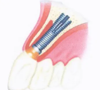 Fig. 3 Sargon Dental Implant 임플란트와  골과의  접촉을  넓히기  위한  Titanium  spra- yed  표면을  가지고  치은에  접한  부분은  고도로  연마되어  있다